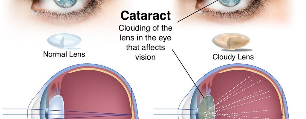 NRf2 y cataratas