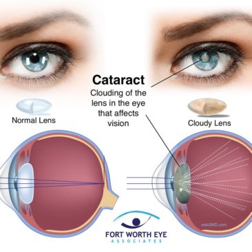 NRf2 y cataratas